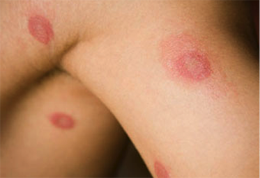 ringworm